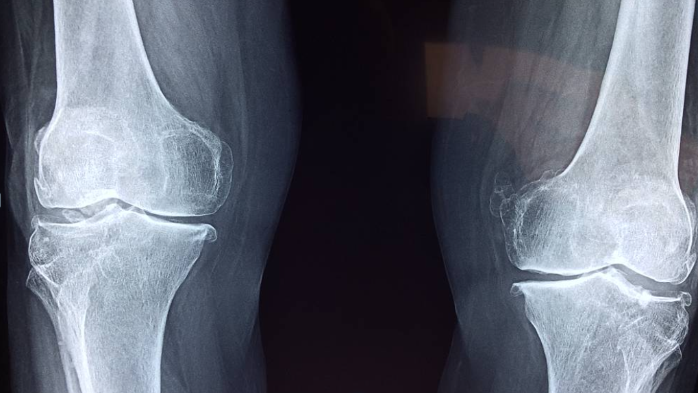 Arthrose : symptômes et traitements